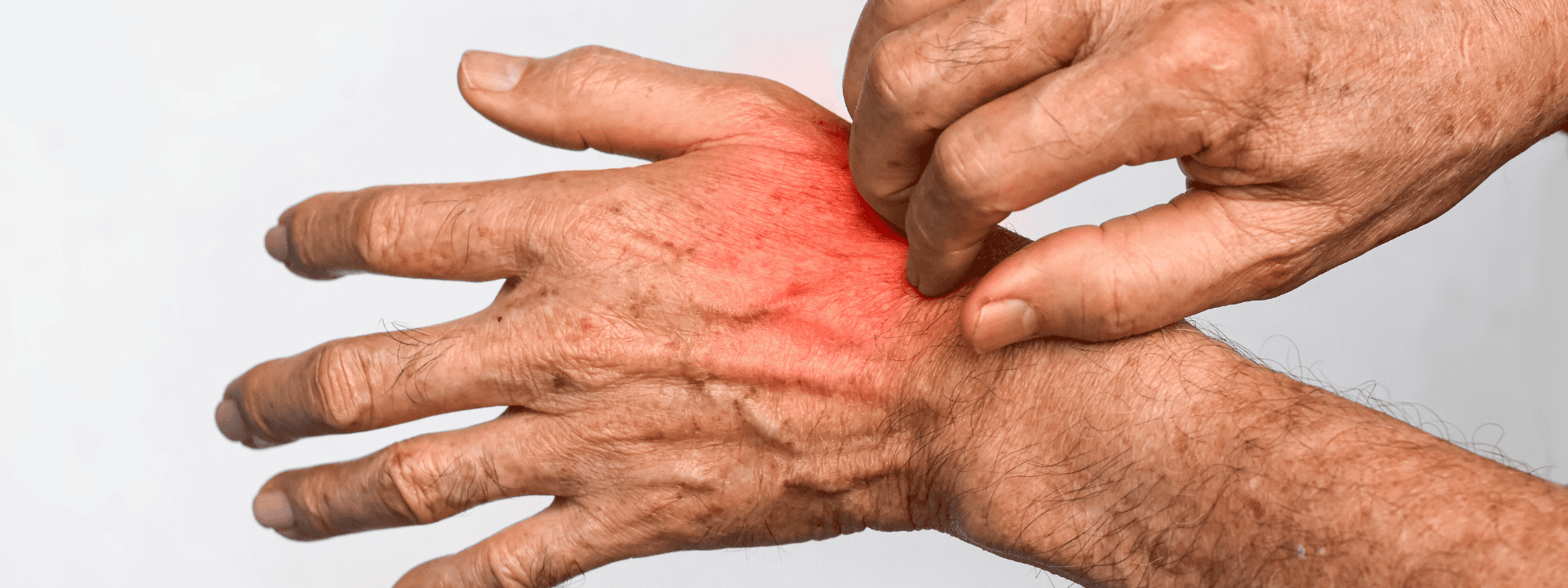 scabies-image1